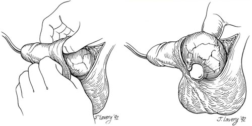 pene dopo la riassegnazione di genere